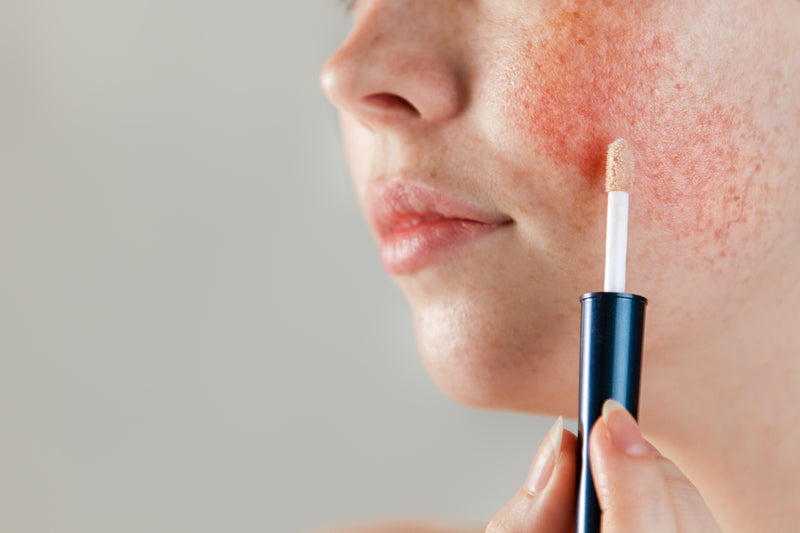 specific products for rosacea skin