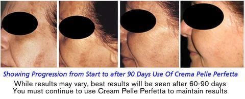 Buy 2 and SAVE 15% Crema Pelle Perfetta – Dermatologist Recommended Treatment for Rosacea, Dark Spots, Sun Damage, and Blemishes with All Natural Ingredients - Buy 2 and Save