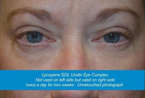 Lycopene Wrinkle Eraser - Erase Wrinkles Naturally in Weeks without Botox